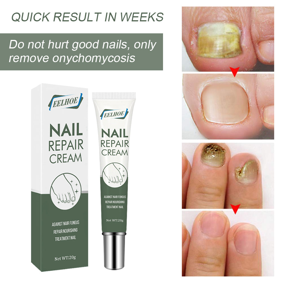 Foot Care And Thickening Nail Repair Cream. Nail Repair Cream